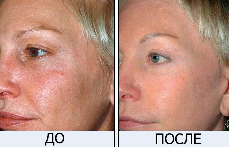 Отзывы коллаген для кожи лица американский гидролизированный коллаген ультра очистки до и после фото 3 - Envie.com.ua