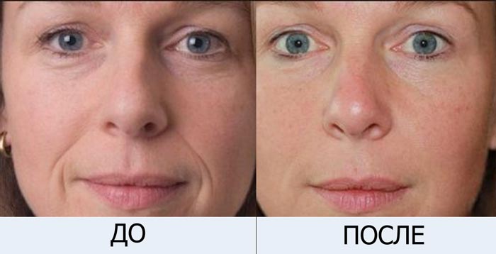 Отзывы коллаген для кожи лица американский гидролизированный коллаген ультра очистки до и после фото 1 - Envie.com.ua