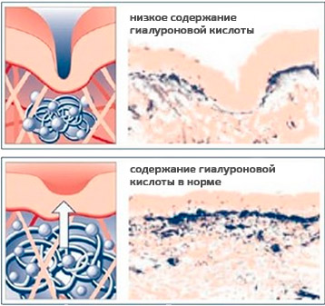 Коллаген с гиалуроновой кислотой. Недостаток гиалуроновой кислоты - для кожи лица и тела, проявление морщина. Как использовать, как принимать, Отзывы, подробное описание.